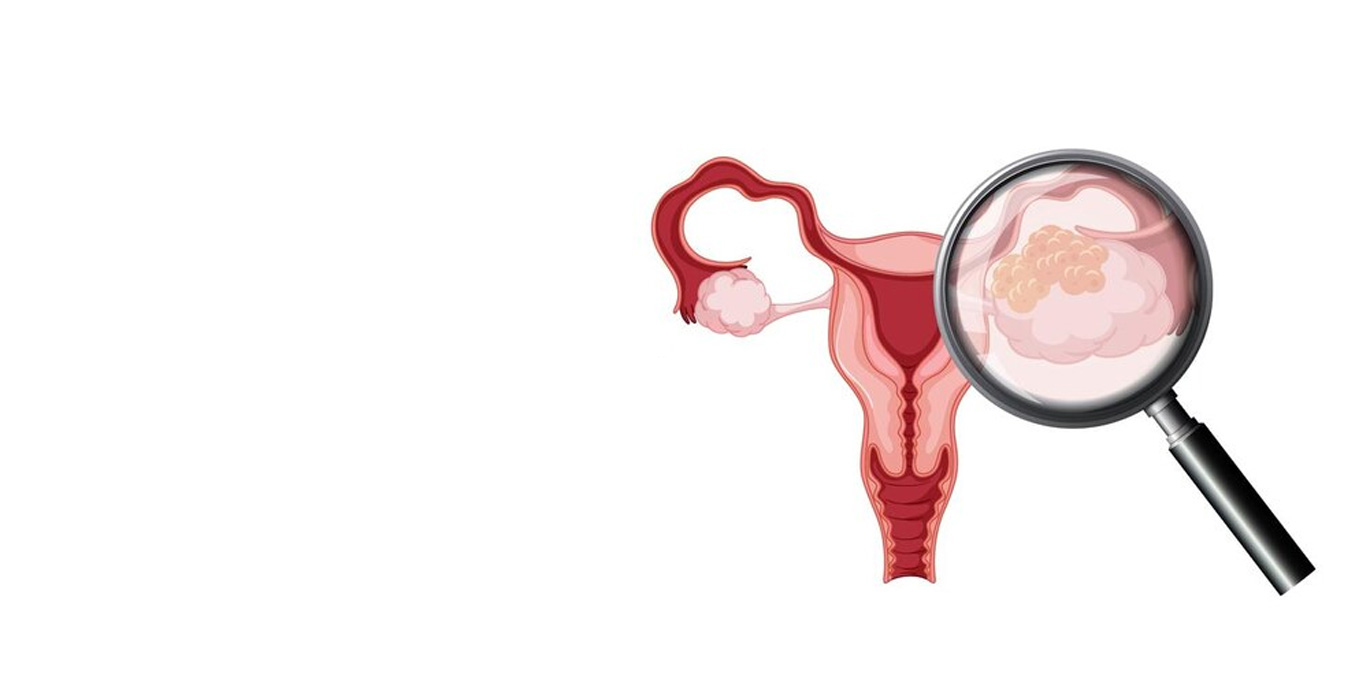 Fallopian Tube Cancer Causes, Symptoms & Treatment Indira IVF