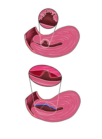 Isthmocele (Cesarean Scar Defect): Symptoms, Diagnosis & Its Impact on Fertility
