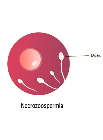 Necrozoospermia: Causes, Symptoms, Diagnosis & Treatment