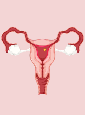 Endometrial Scratch