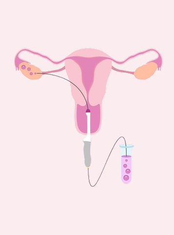 How to Make IVF Successful the First Time