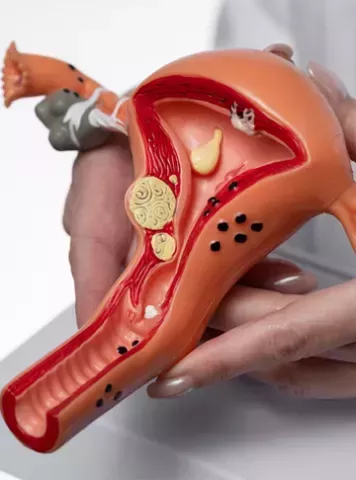 All You Need to Know About Ovarian Torsion