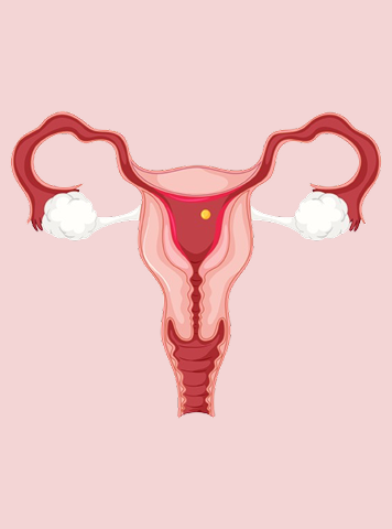 Endometriosis Diet in Hindi 