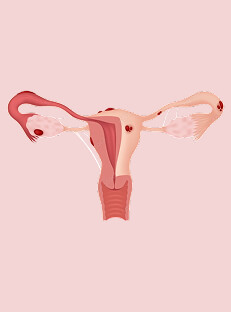 Fallopian Tube Blockage in Hindi