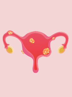 Bulky Uterus in Hindi