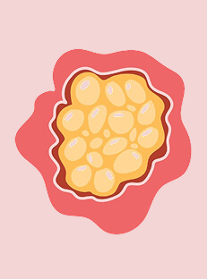 लेफ्ट ओवेरियन सिस्ट क्या है? इसके कारण, लक्षण और उपचार (Left Ovarian Cyst in Hindi)