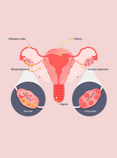 PCOS क्या होता है? पीसीओएस के लक्षण, कारण और इलाज  (PCOS Kya Hota Hai)