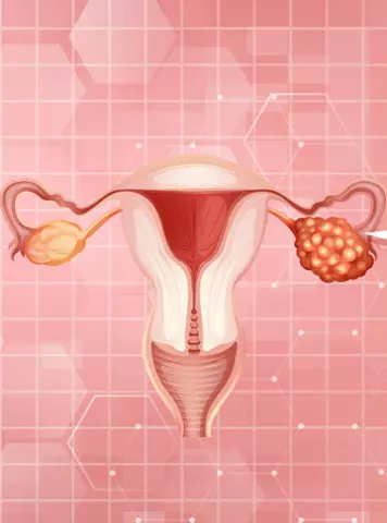 Ovarian Cyst Causes