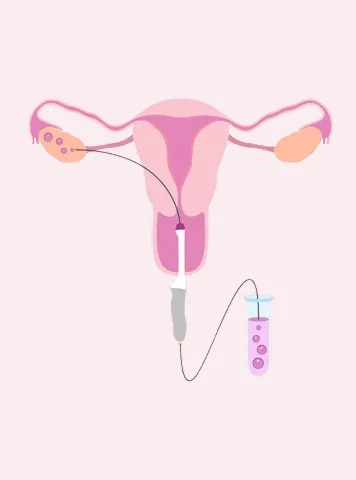 How to Make IVF Successful the First Time