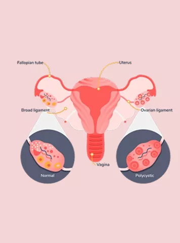 PCOD vs PCOS