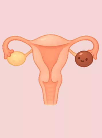 Chocolate Cyst
