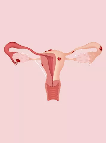 How to Get Pregnant Fast With Blocked Fallopian Tubes