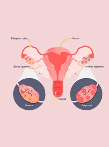 How to get pregnant with PCOS?