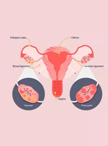 PCOD Symptoms: Recognize the Signs and Seek Timely Care