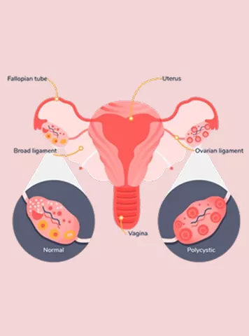 How to Know if You Have PCOS: A Complete Guide