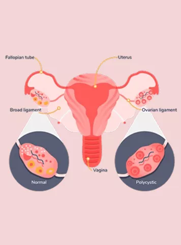 PCOD અને PCOS: મુખ્ય તફાવતો, લક્ષણો અને ઉપચાર