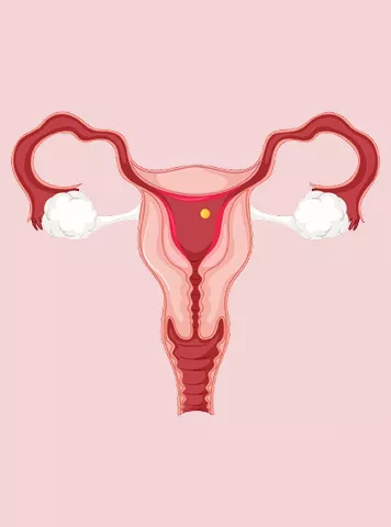 Endometriosis Signs That Affect Fertility and Pregnancy