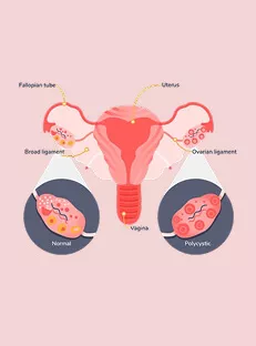 PCOS/PCOD Do’s and Don’ts