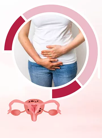 Adenomyosis