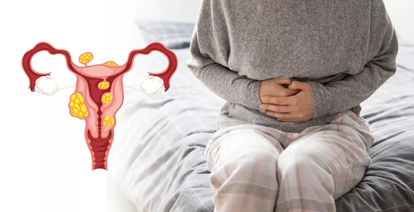 Fibroids And Infertility: Few Facts Must Be Known