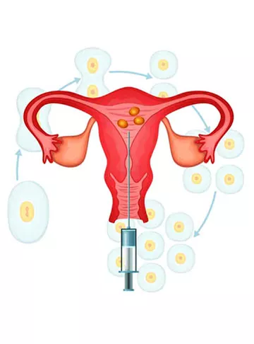 Advantages and Disadvantages of IUI