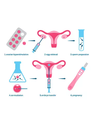 Steps involved in the Process of In Vitro Fertilisation(IVF) | Indira IVF