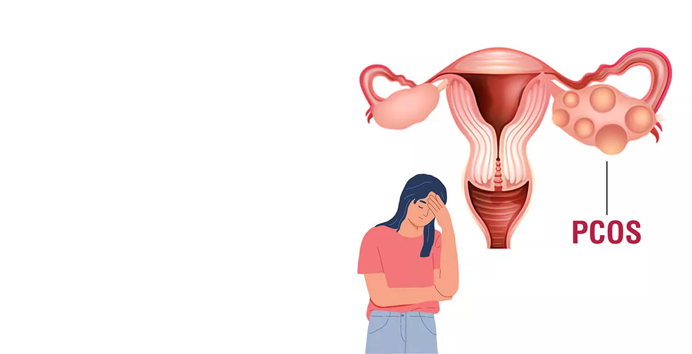 PCOS