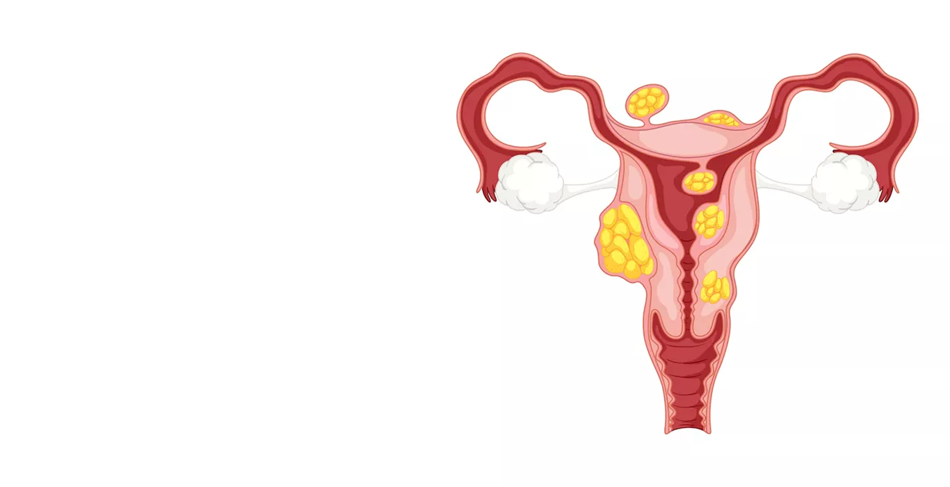 Uterine Fibroids