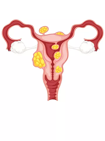 Uterine Fibroids