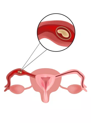 Ectopic Pregnancy