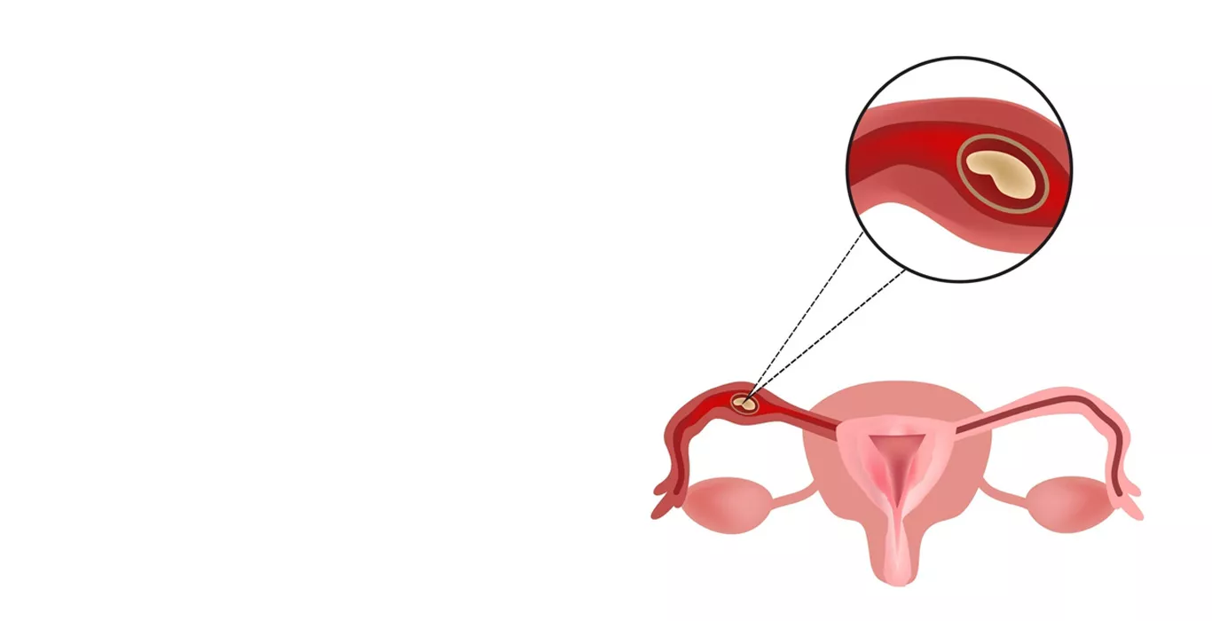 Ectopic Pregnancy