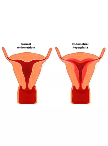 Endometrial Hyperplasia (Thick Endometrium)