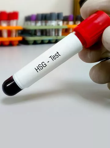 Understanding the HSG Test: Meaning and Importance