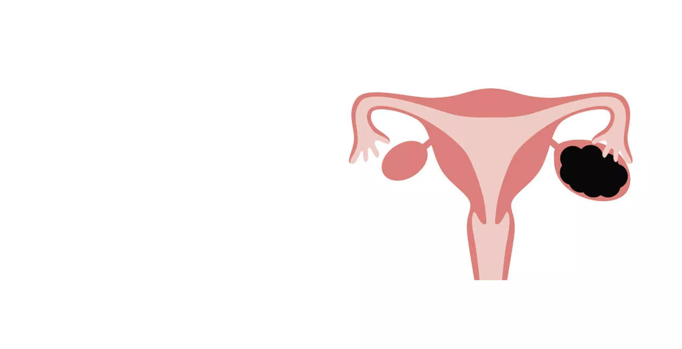 Chocolate Cyst (Ovarian Endometrioma)