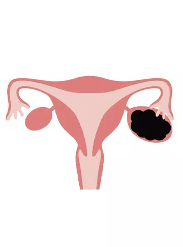 Chocolate Cyst (Ovarian Endometrioma)