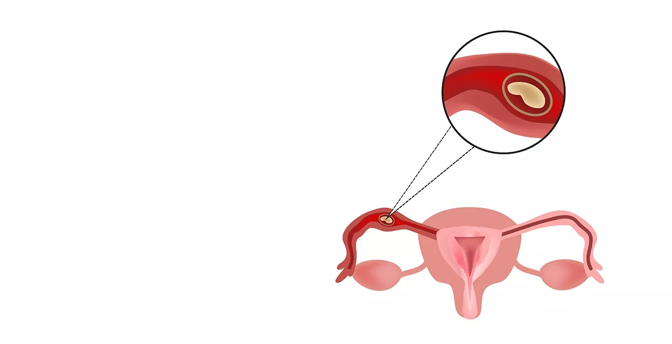 Ectopic Pregnancy