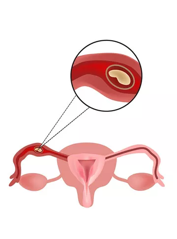 Ectopic Pregnancy
