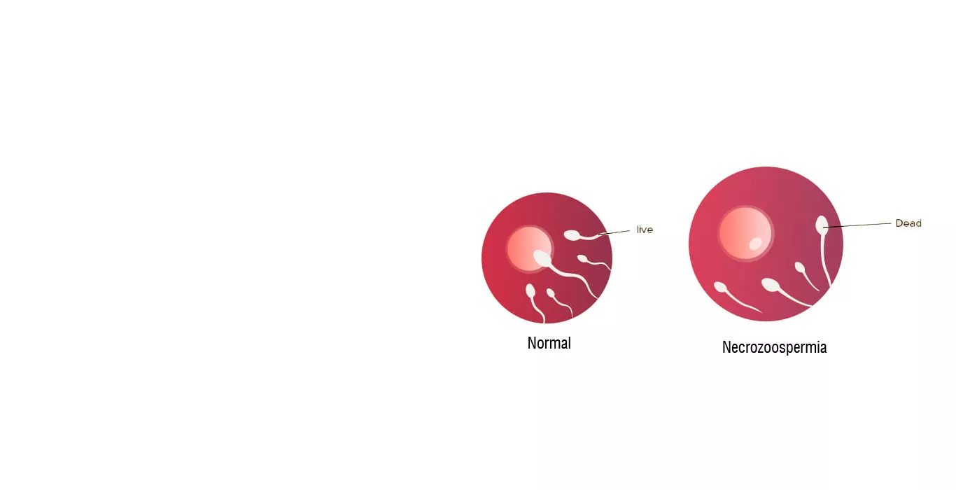 Necrozoospermia
