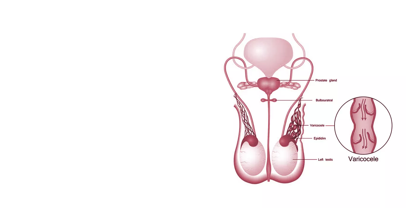 Varicocele