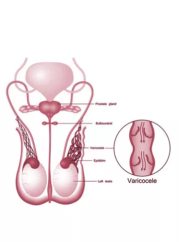 Varicocele: Causes, Symptoms & Treatment