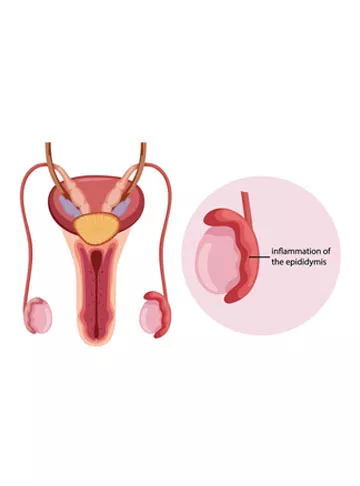 Epididymitis