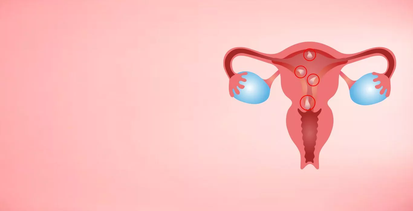 Endometrial Polyps (Uterine Polyps)