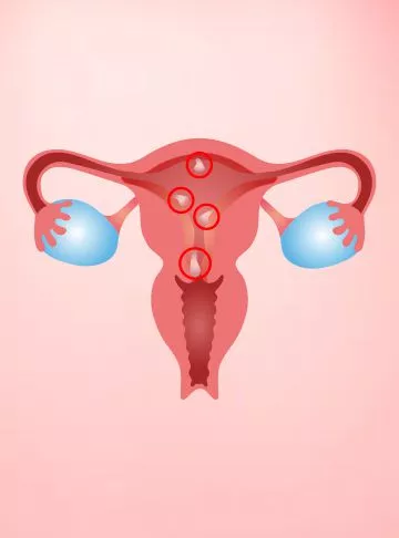Endometrial Polyps (Uterine Polyps)