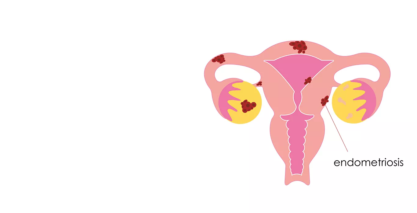 Endometriosis