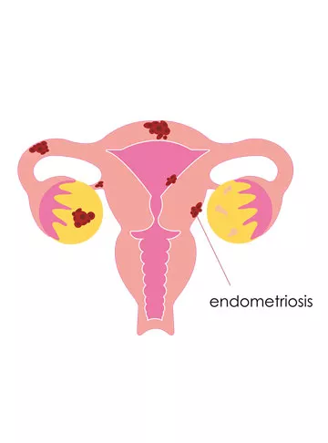 Endometriosis