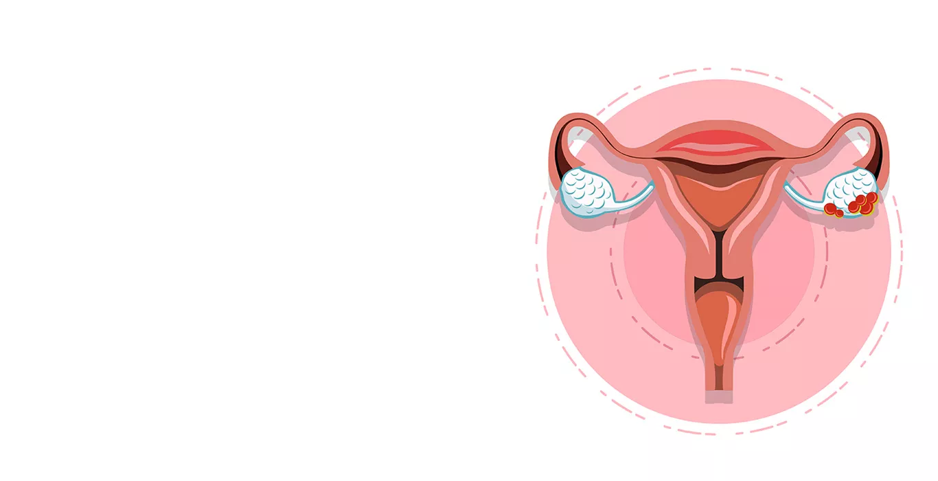 Ovarian Cysts