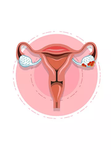 Ovarian Cysts