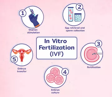 5 Stages of IVF
