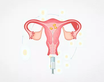 Treatments Offered <a href='/infertility-treatment/intrauterine-insemination-iui-treatment'>Intrauterine Insemination (IUI)</a>