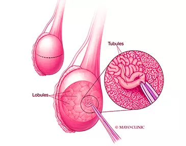 Treatments Offered <a href='/advanced-infertility-treatment/micro-tese'>Micro TESE</a>